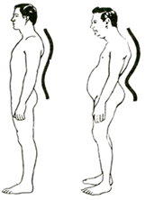 obesita-dolore-lombare