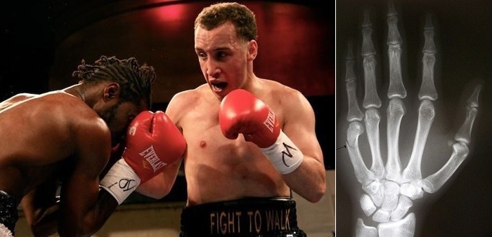boxing injuries